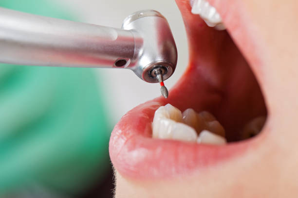Best Emergency Treatment for Dental Infections or Abscesses in Avenal, CA